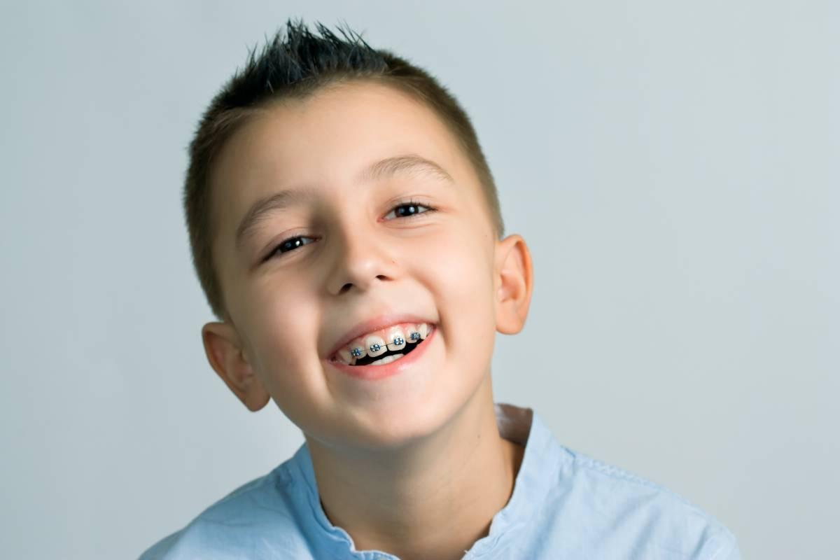 Fact or Fiction: Tooth Extractions Before Getting Braces