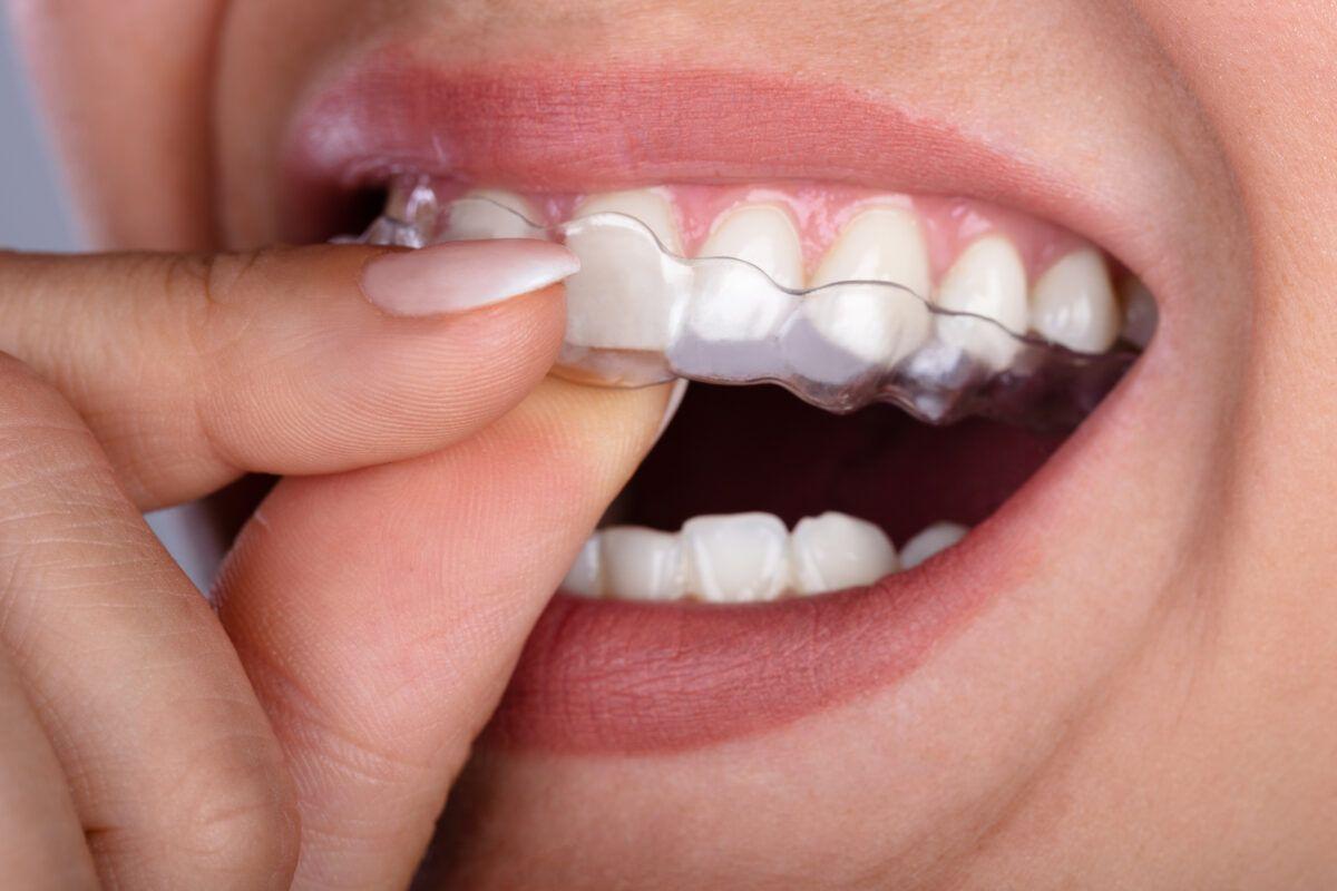 ClearAligner in San Diego CA