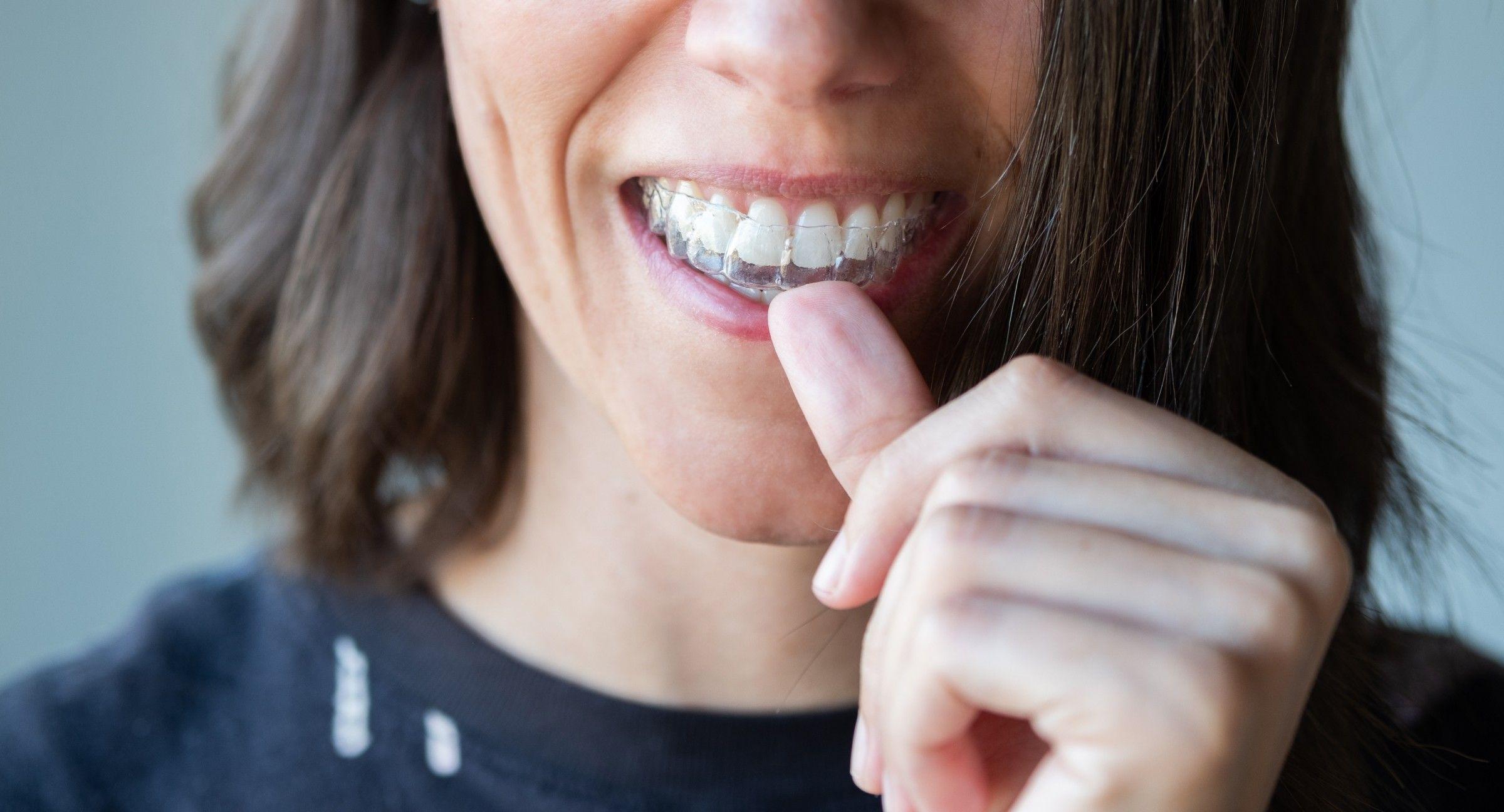 Invisalign Effectiveness: Straightening Teeth Discreetly
