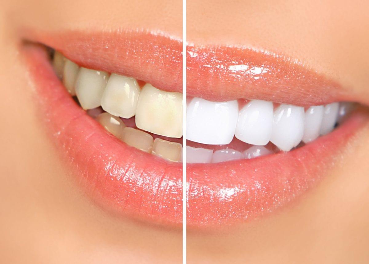 How to Reveal Your Brightest Smile