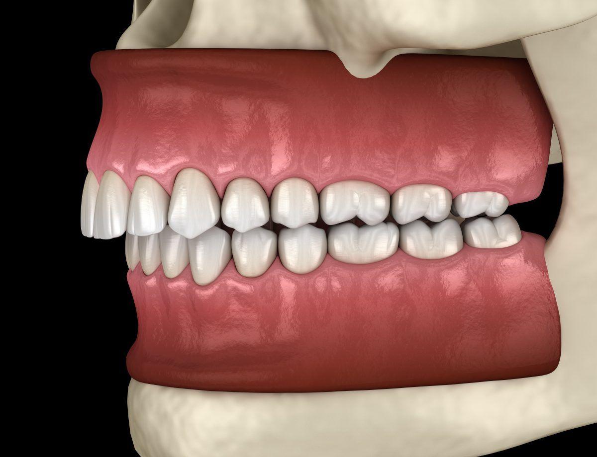 San Diego Invisalign Dentists