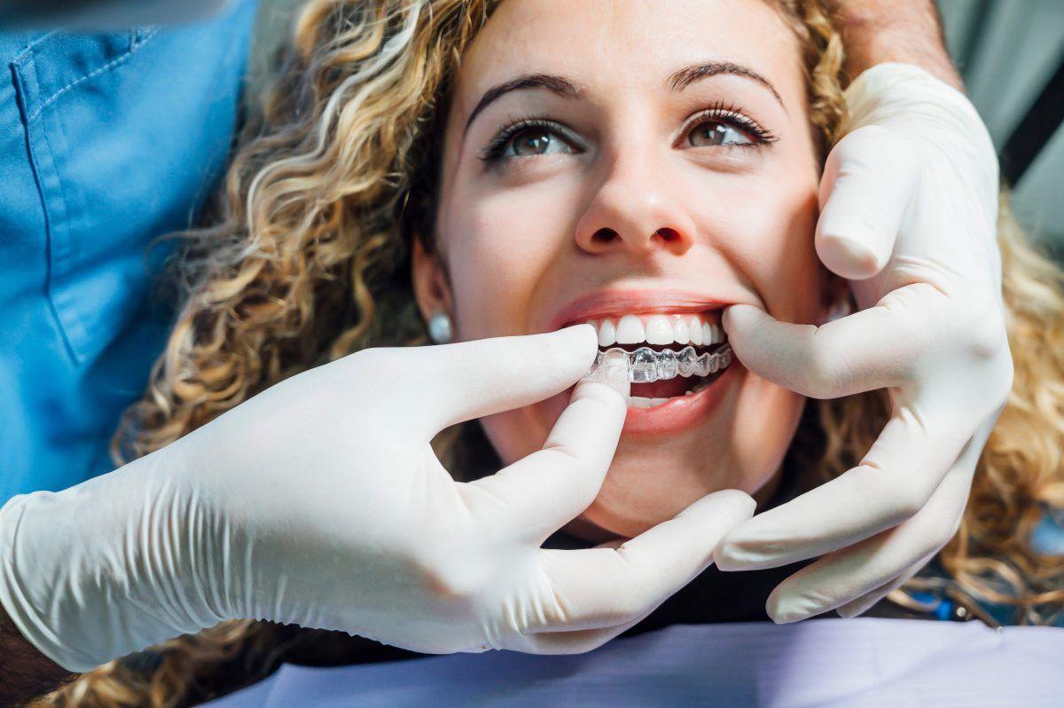 clear aligners in San Diego