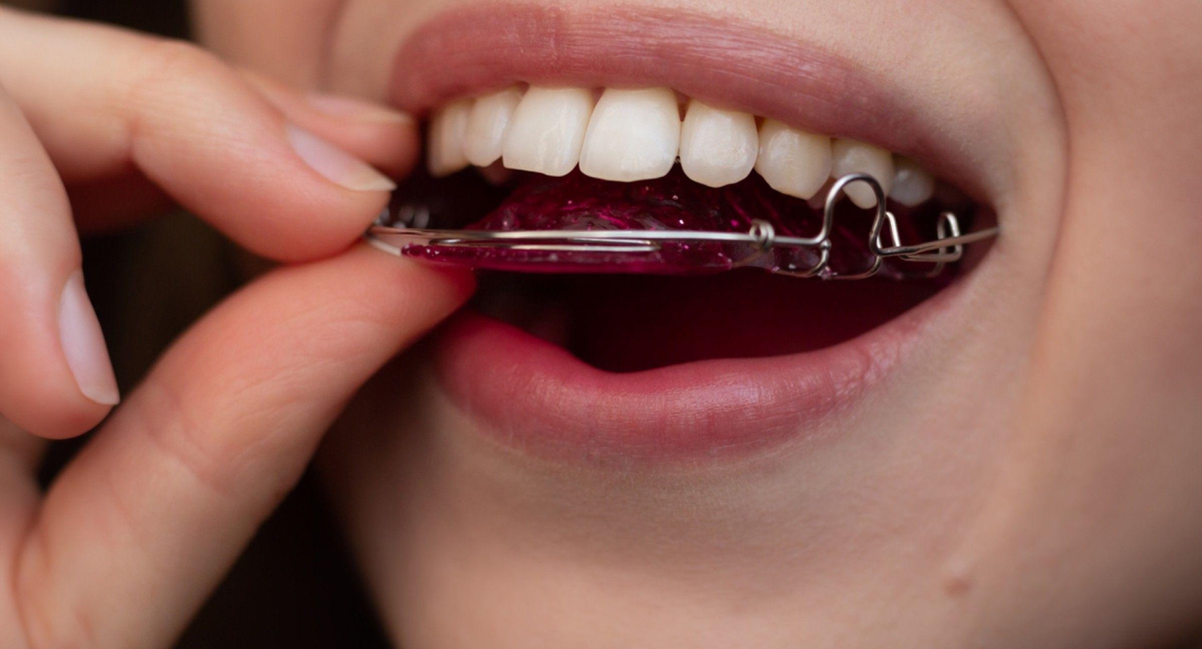 The Importance of Retainers: Maintaining Your Smile After Braces